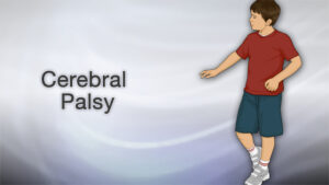 WHAT CAUSES CEREBRAL PALSY